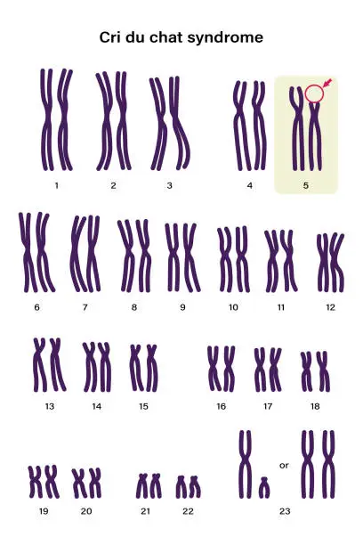 Vector illustration of Human karyotype of Cri du chat syndrome. Autosomal abnormalities. A piece of chromosome 5 is missing