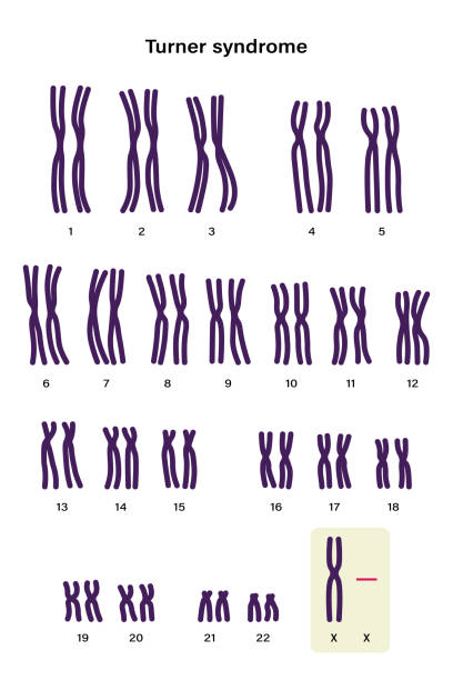 터너 증후군의 인간 카요타입. x 염색체 중 하나 (성 염색체)는 누락되었거나 부분적으로 누락되었습니다. 45,x 또는 45,x0 - symbol sex healthcare and medicine healthy lifestyle stock illustrations