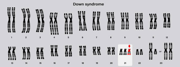 кариотип человека синдрома дауна. аутосомные аномалии. трисомия 21. генетическое заболевание. - chromosome stock illustrations