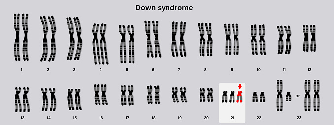 Human karyotype of Down syndrome. Autosomal abnormalities. Trisomy 21. Genetic disorder.