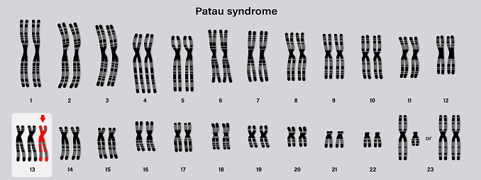 Human karyotype of Patau syndrome. Autosomal abnormalities. Trisomy 13. Genetic disorder.