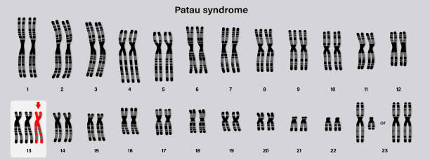Human karyotype of Patau syndrome. Autosomal abnormalities. Trisomy 13. Genetic disorder. Human karyotype of Patau syndrome. Autosomal abnormalities. Trisomy 13. Genetic disorder. patau syndrome stock illustrations