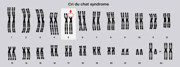 Vector illustration of Human karyotype of Cri du chat syndrome. Autosomal abnormalities. A piece of chromosome 5 is missing.