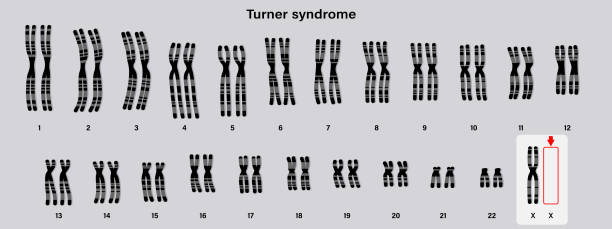 ターナー症候群のヒト核型。x染色体の1つ(性染色体)が欠けているか、部分的に欠けている。45、x、または45,x0。 - symbol sex healthcare and medicine healthy lifestyle点のイラスト素材／クリップアート素材／マンガ素材／アイコン素材