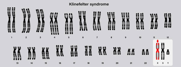 클라인 펠터 증후군의 인간 카요타입. 클라인펠터, ks 또는 xxy. - symbol sex healthcare and medicine healthy lifestyle stock illustrations