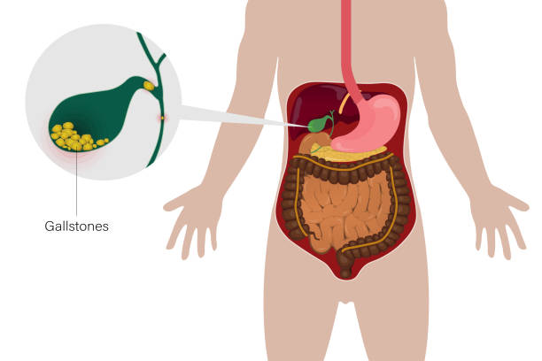 ilustraciones, imágenes clip art, dibujos animados e iconos de stock de cálculos biliares en la vesícula biliar. órganos digestivos. hígado. estómago. páncreas. intestinos. esófago. - conducto partes del cuerpo