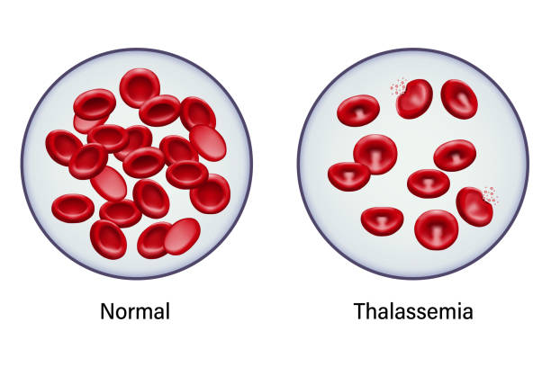 ilustrações, clipart, desenhos animados e ícones de diagrama de comparação entre glóbulos vermelhos normais e talassemia. - célula alfa