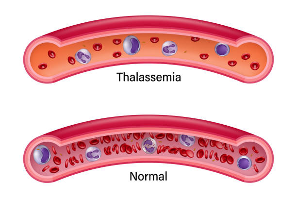 ilustrações, clipart, desenhos animados e ícones de comparação entre glóbulos vermelhos normais e talassemia. educação médica. - célula alfa