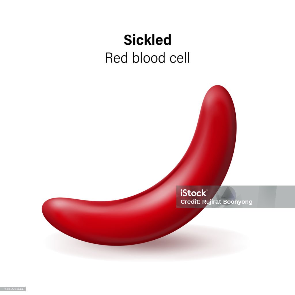Sickled Rbc Sickle Cell Disease Sickled Red Blood Cells Vector Stock Illustration ...