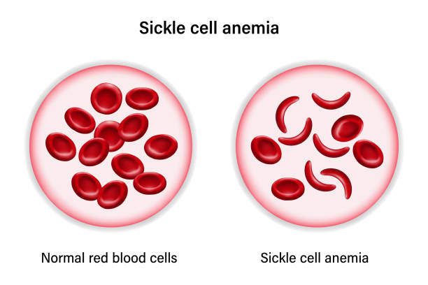 sichelzellenanämie. der unterschied von normalen roten blutkörperchen und sichelzellen. - anemia stock-grafiken, -clipart, -cartoons und -symbole