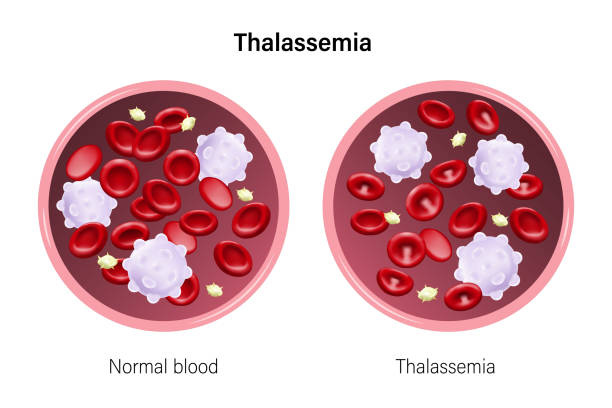 ilustrações, clipart, desenhos animados e ícones de talassemia. a diferença de talassemia sanguínea e sangue normal. glóbulos vermelhos, glóbulos brancos e plaquetas. - célula alfa