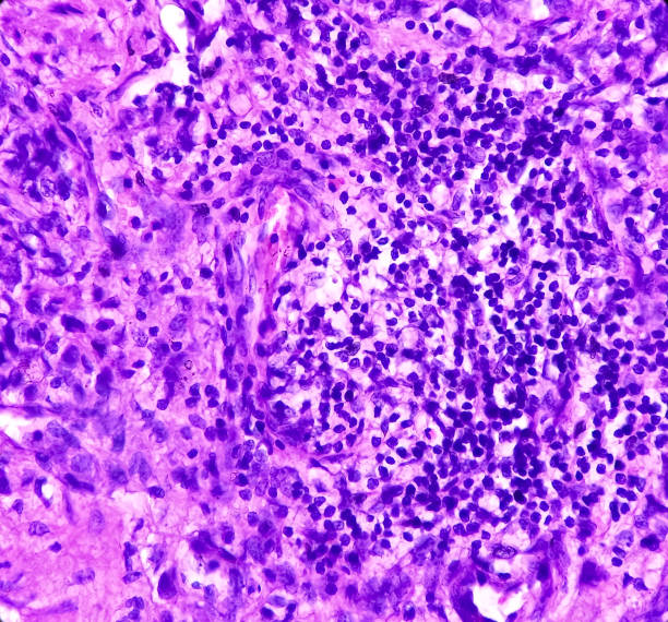 istock Prostate Cancer(TURP): adenocarcinoma, malignant neoplasm,atypical epithelial cells, malignant tumor 1385684748