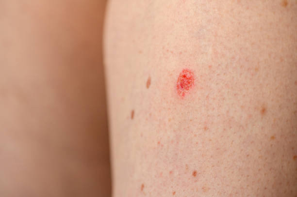 istock Seborrheic Keratosis after the laser removal 1385756787