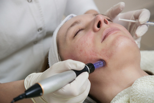 Mesoterapia. Mujer que recibe tratamiento facial dermapen. Tratamiento cosmético con micro agujas en dermatólogo. photo