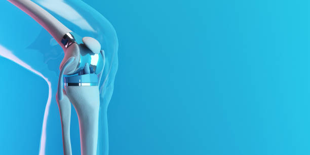 sostituzione di ginocchio - artificial metal healthcare and medicine technology foto e immagini stock