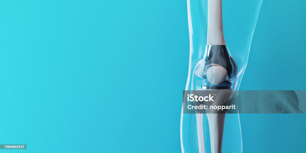 Knee Replacement x-ray show knee joint replacement Human Spine Stock Photo