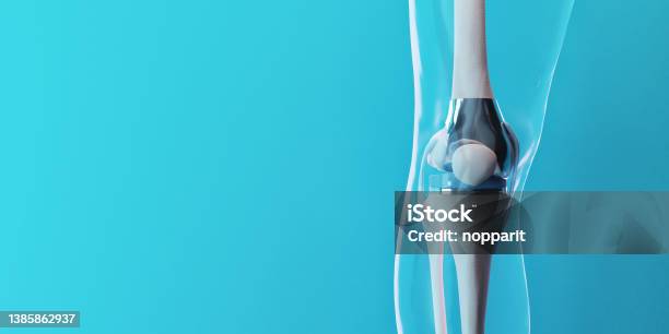 Knee Replacement Stock Photo - Download Image Now - Human Spine, Knee, Surgery