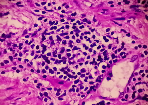 Prostate Cancer: Microscopic image of prostatic tissue, adenocarcinoma, malignant neoplasm, atypical epithelial cells.