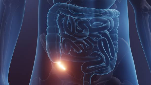 appendix - blindtarmsinflammation bildbanksfoton och bilder