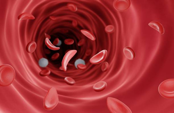 Sickle cell disease Sickle cells in blood vessel sickle cell stock pictures, royalty-free photos & images
