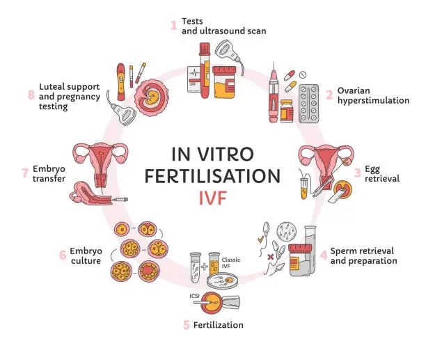 Vector illustration of In Vitro fertilization IVF vector circle infographic and infertility treatment
