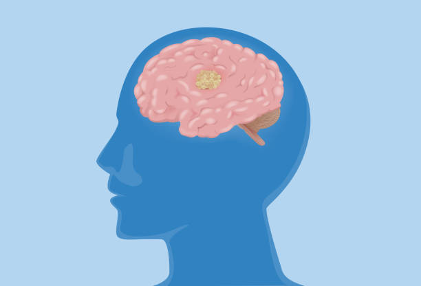 stockillustraties, clipart, cartoons en iconen met the brain in the silhouette human head has a tumor. medical diagram about cancer cell metastasis at the human internal organ and nervous system. - kleine hersenen