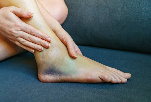 istock Female leg with bruises and swelling. 1386032665