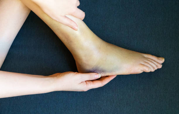 istock Female leg with bruises and swelling. 1386032671