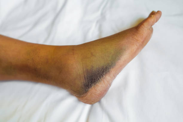 istock Female leg with bruises and swelling. 1386032675