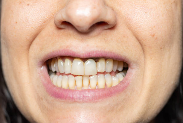 istock Gum retraction and dental implant 1386036452