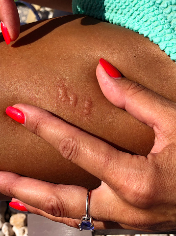 Woman checking a Jellyfish sting creating a painful rash on her leg