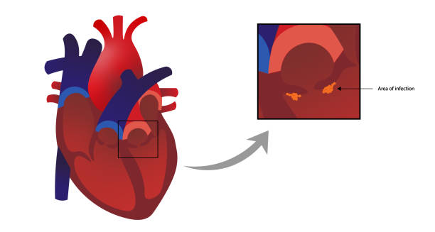 endokarditis. nahaufnahme einer aortenklappe mit infektionsbereichen. - endokarditis stock-grafiken, -clipart, -cartoons und -symbole