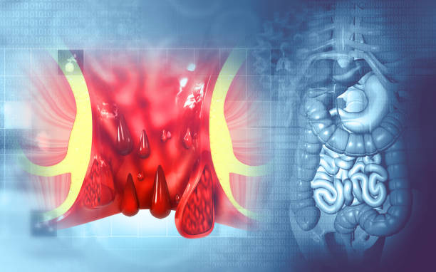Haemorrhoids (piles) on scientific background. 3d illustration Haemorrhoids (piles) on scientific background. 3d illustration blood and guts stock pictures, royalty-free photos & images