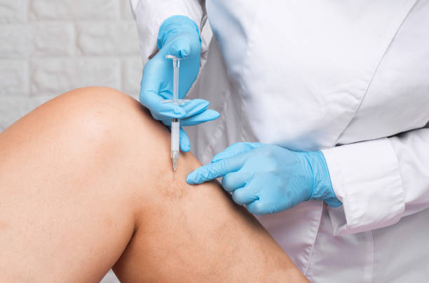 Removal of varicose veins on the legs. Medical inspection and treatment of Telangiectasia. Phlebeurysm. Removal of varicose veins on the legs. Medical inspection and treatment of Telangiectasia. Phlebeurysm. spider veins stock pictures, royalty-free photos & images