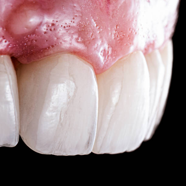 istock ceramic crowns and veneers b3 color 1386506970