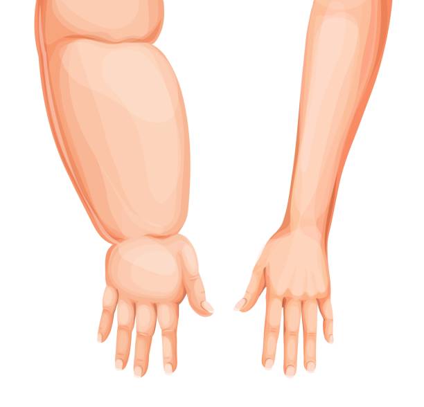 obrzęk, obrzęk ręki lub ramienia, obrzęk limfatyczny - insufficiency stock illustrations