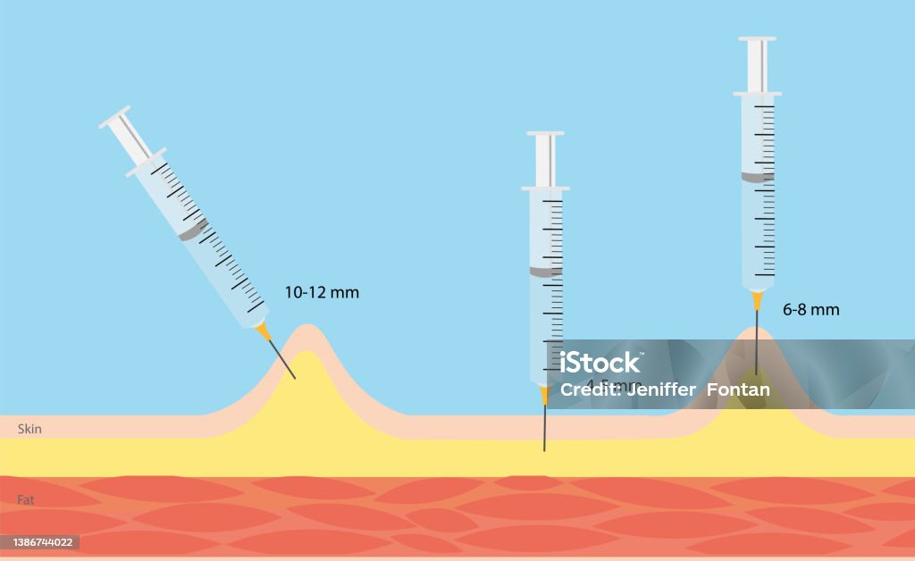 Tehnik Injeksi Teknik Injeksi Insulin Ilustrasi Stok - Unduh Gambar Sekarang - Kulit ...