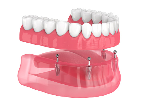 All-on-4 removable, implants supported, overdenture installation over white background
