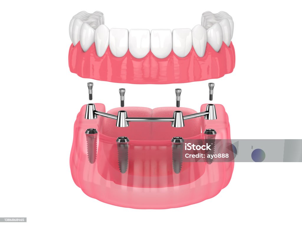 Removable overdenture installation on bar clip attachment, supported by implants Removable overdenture installation on bar clip attachment, supported by implants over white background Dentures Stock Photo