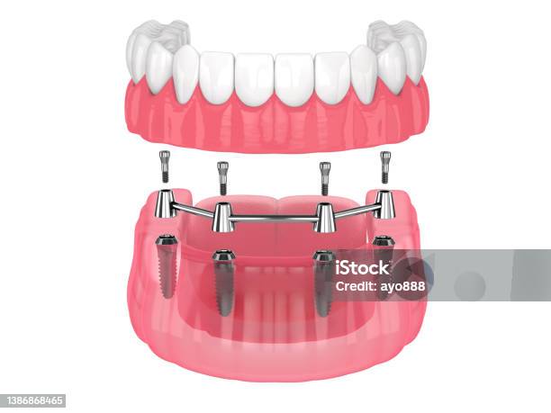 Removable Overdenture Installation On Bar Clip Attachment Supported By Implants Stock Photo - Download Image Now