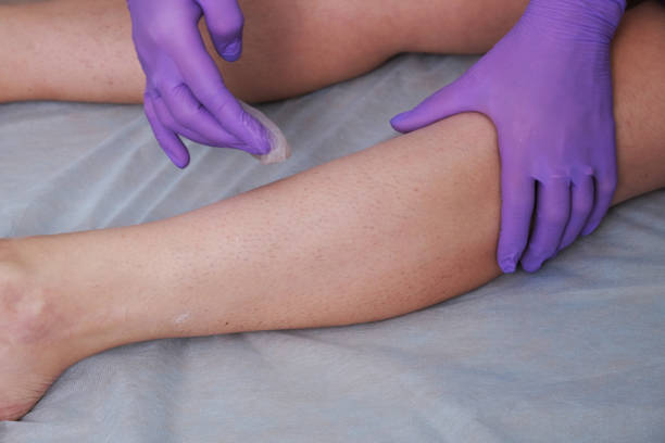 istock Sugaring epilation skin care with liquid sugar at legs. 1386969201