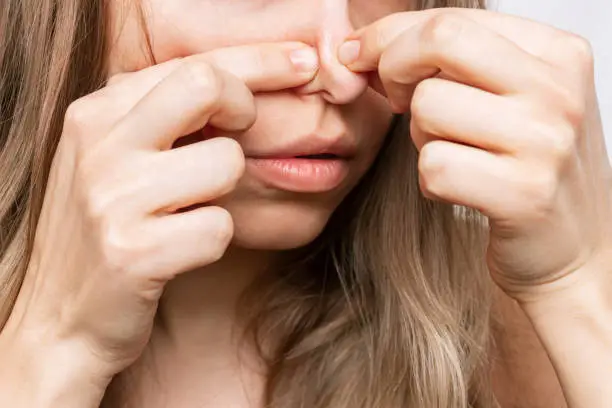 Cropped shot of a young woman squeezing out a black heads or comedones with her fingers. Acne problem, pimples. Cosmetology dermatology concept