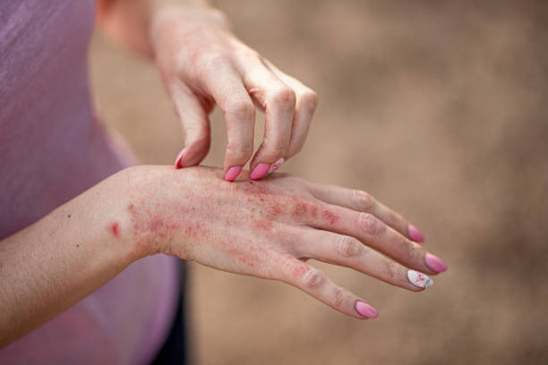 ekzem-dermatitis an händen und füßen. rote flecken auf der haut. trockene hautdas konzept dermatologie, behandlung pilz. frau kratzt sich an der hand - eczema stock-fotos und bilder