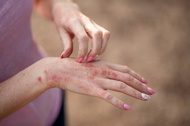 eczema dermatitis on hands and feet. red spots on the skin. dry skinthe concept dermatology, treatment fungal. woman scratching her hand - wound blood human finger human hand imagens e fotografias de stock