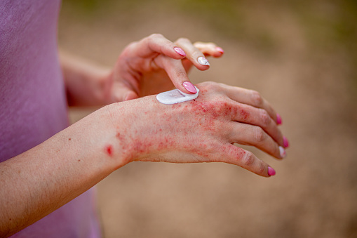 Eczema en las manos. La mujer que aplica el ungüento, cremas en el tratamiento de eczema, psoriasis y otras enfermedades de la piel. Concepto de problema de la piel photo