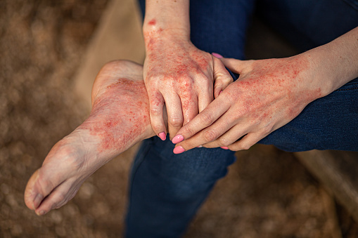 dermatitis por eccema en manos y pies. manchas rojas en la piel. piel seca photo