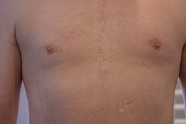 수술 흉터 - pacemaker torso chest male 뉴스 사진 이미지