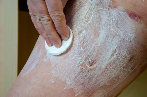 la mujer aplica crema a la piel afectada por quemaduras térmicas. tratamiento de heridas, eliminación de cicatrices, cuidado de la piel - second skin fotografías e imágenes de stock