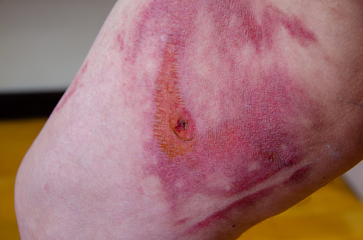 Thermal burn of the skin in the healing stage. Burnt skin on the thigh, domestic injury from boiling water, close-up. Second degree burn. selective focus