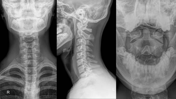 istock cervical spine of a patient in different projection. 1387275919